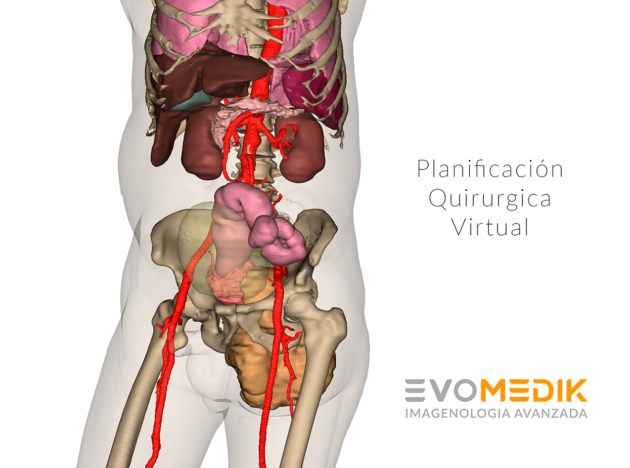 evomedik planificacion quirurgica virtual